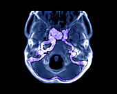 Pulsatile exophthalmos, CT angiogram
