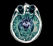 Cerebral atrophy, illustration