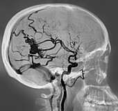 Arteriovenous malformation, CT angiogram