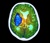 Cerebral haemorrhage, CT scan