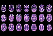 Normal brain of a child, MRI scans