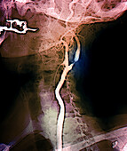 Narrowed carotid artery, digital angiogram