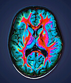 Healthy brain, MRI scan