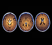 Subarachnoid haemorrhage, MRI scans