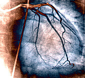 Normal left coronary network, angiogram