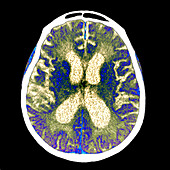 Alzheimer's disease, CT scan