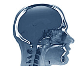 Normal nasopharynx, CT scan
