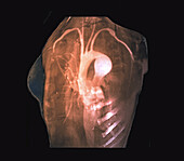 Aneurysm in Marfan syndrome, MRI angiogram