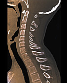 Healthy cervical spine, CT scan