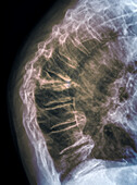Osteoporotic spinal compression, X-ray