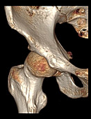 Healthy hip joint, CT scan