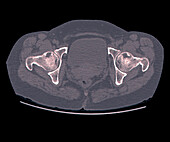 Osteonecrosis of the hips, CT scan