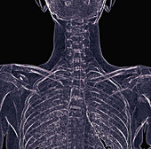 Healthy rib cage, X-ray