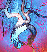 Aortic aneurysm, angiogram