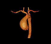 Thoracic aorta aneurysm, CT angiogram