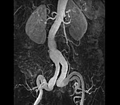 Aneurysm of iliac and renal arteries, MRI angiogram