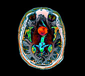 Aneurysm of the internal carotid artery, MRI scan