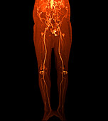 Aortoiliac occlusive disease, CT angiogram