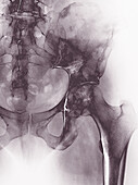 Secondary bone cancer, X-ray
