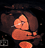 Aortic valve insufficiency, CT scan