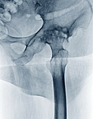 Osteoarthritis of the hip, X-ray