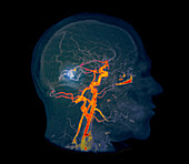 Brain haemorrhages, MRI angiogram