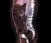 Aortoiliac occlusive disease, CT angiogram