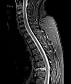 Spinal cancer, MRI scan