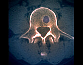 Schmorl's node, CT scan