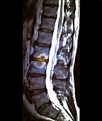 Schmorl nodules, MRI scan