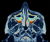 Sinusitis, MRI scan