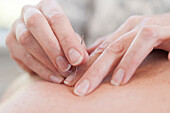 Acupuncture treatment