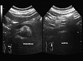 Normal pancreas and aorta, ultrasound scans