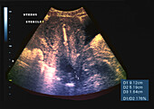 Normal uterus, ultrasound scan