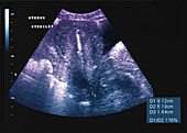 Normal uterus and IUD device, ultrasound scan