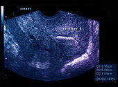 Normal uterus with IUD device, ultrasound scan