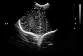 Normal premature newborn baby brain development, ultrasound