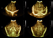 Premature baby normal brain development, ultrasound scan