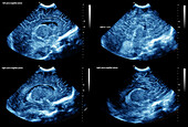 Premature baby normal brain development, ultrasound scans