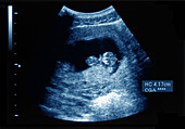 Intrauterine pregnancy, ultrasound scan