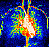 Healthy heart and blood vessels, MRI angiogram