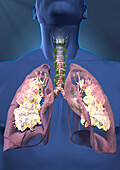 Lung cancer, illustration