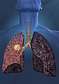 Smoker's lungs with oat cell carcinoma, illustration