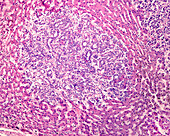 Hepatocellular carcinoma, light micrograph