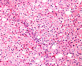 Fatty liver disease, light micrograph
