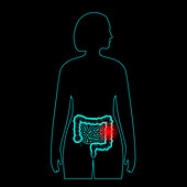 Intestine disease, illustration