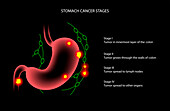 Stomach cancer, illustration