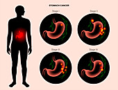 Stomach cancer, illustration