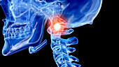 Painful atlas vertebrae, illustration