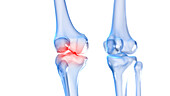 Painful knee, illustration